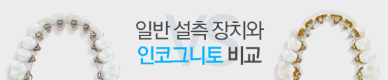 일반 설측장치와 인코그니토 비교