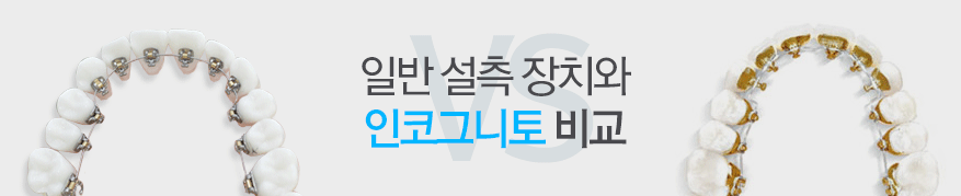 일반 설측 장치와 인코그니토 비교